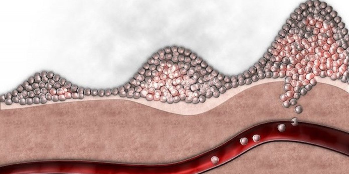 Durante la metástasis, las células cancerosas se desprenden del tumor primario y viajan a otros lugares del cuerpo a través de la sangre o la linfa (Crédito: Gunilla Elam / Science Source).